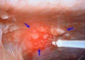 Пути лечения канцероматоза брюшной полости