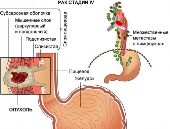 возникновение рака в пищеводных отверстиях