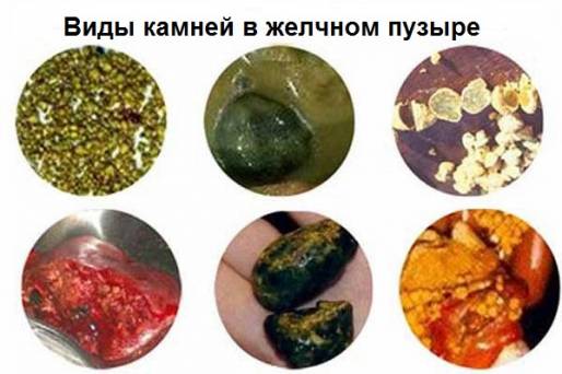 разновидности желчных камней