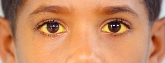желтый оттенок глаз