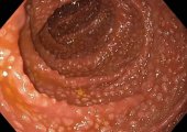 Что такое гиперплазия слизистой желудка?