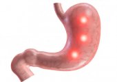 Методы лечения ксантомы желудка