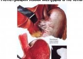 Пенетрирующая язва желудка и 12 перстной кишки