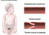 Инвагинация кишечника у детей и взрослых