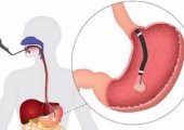 Как проводится процедура биопсии желудка?