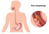 Выживаемость при раке пищевода 4 стадии