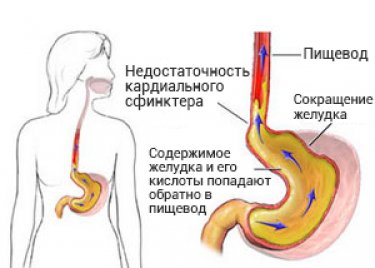 Лечение пилорического сфинктера желудка
