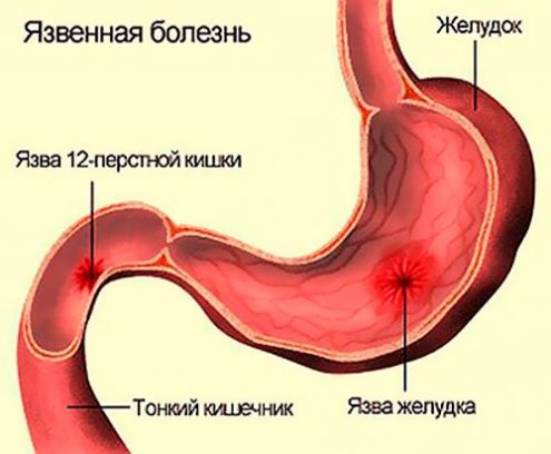 Лечение пилорического отдела желудка